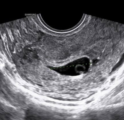 an early stage pregnancy ultrasound image
